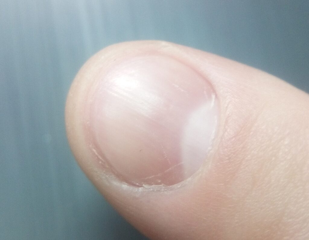 Что делать когда болит под ногтем на руке