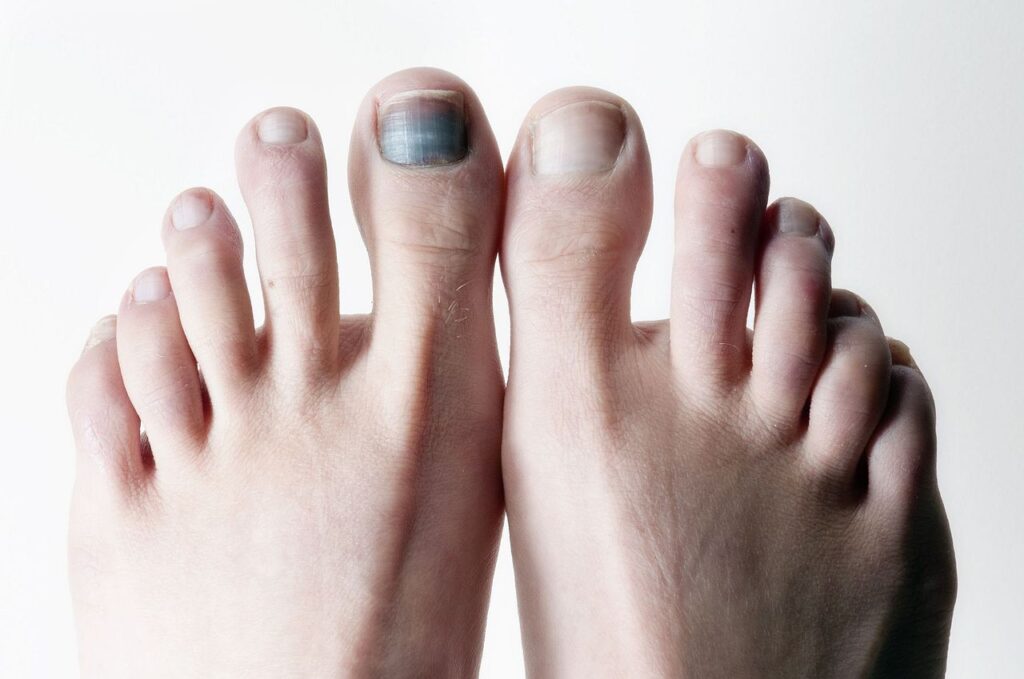 От чего синеют ногти на ногах