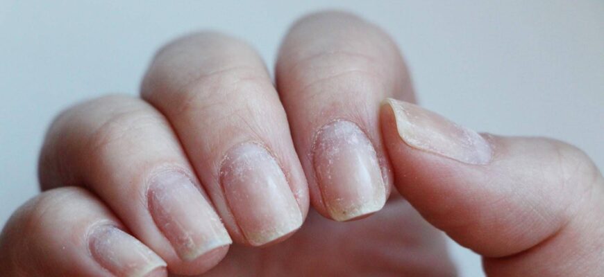 Восстановление ногтей после снятия
